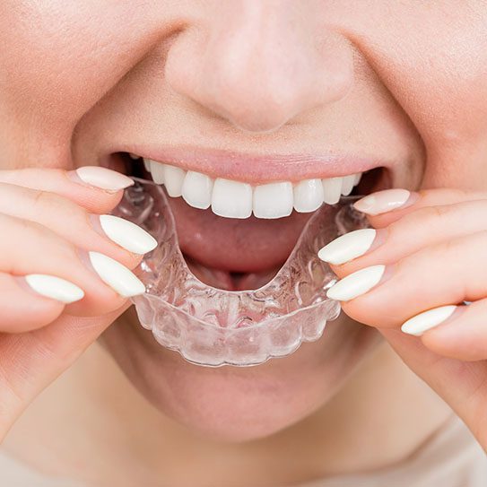 Invisalign